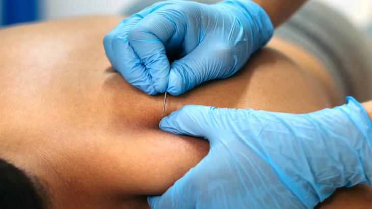 Curso Intensivo de Dry Needling